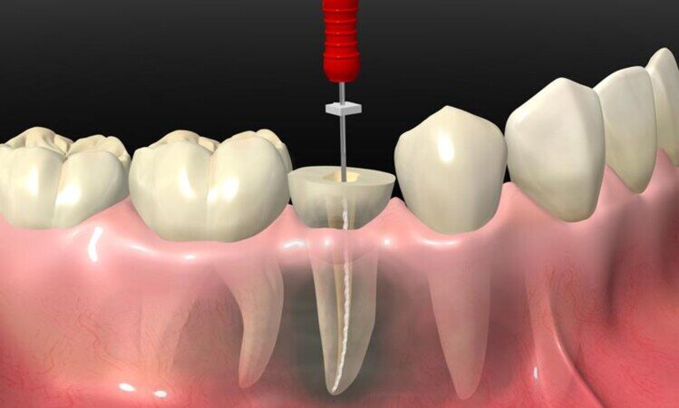Clínica dental osorno, clínica osorno, dentista osorno, limpieza dental osorno, ortodoncia, frenillos, ortodoncia osorno, frenillos osorno, endodoncia, prótesis osorno